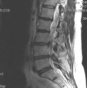 Lumbar MRI T1 Herniated Disc